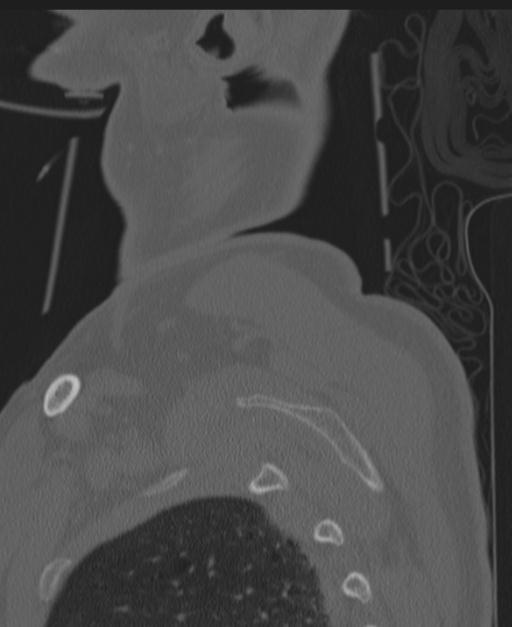 Cerebral hemorrhagic contusions and cervical spine fractures (Radiopaedia 32865-33841 Sagittal bone window 101).jpg