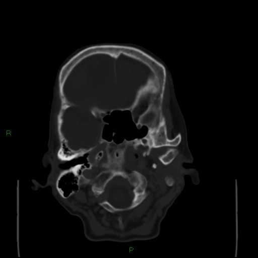 Cerebral metastases - breast primary (Radiopaedia 77653-89857 Axial bone window 22).jpg