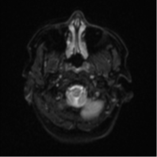 Cerebral metastases mimicking abscesses (Radiopaedia 45841-50131 Axial DWI 4).png
