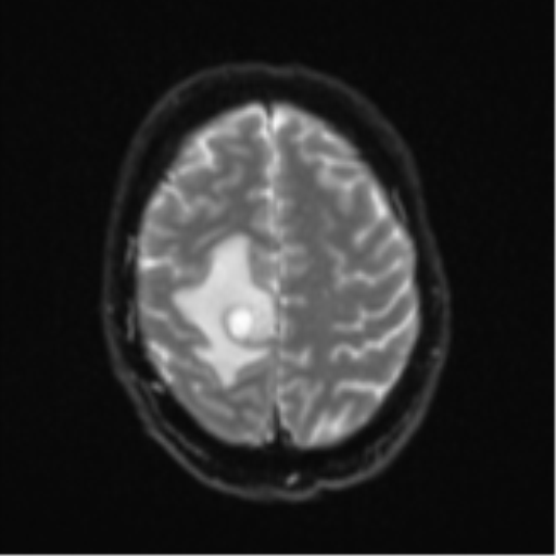 Cerebral metastasis - colorectal adenocarcinoma (Radiopaedia 50394-55765 Axial DWI 22).png