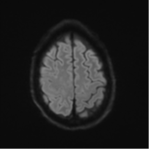 Cerebral metastasis - melanoma (Radiopaedia 54718-60954 Axial DWI 55).png