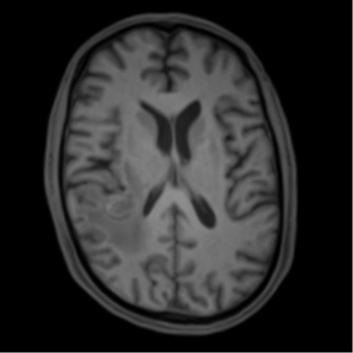 Cerebral metastasis - melanoma (Radiopaedia 54718-60954 Axial T1 31).png