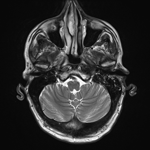 File:Cerebral metastasis - melanoma (Radiopaedia 54718-60954 Axial T2 6).png
