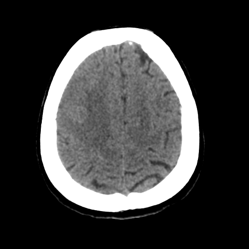 Cerebral metastasis to basal ganglia (Radiopaedia 81568-95412 Axial non-contrast 48).png