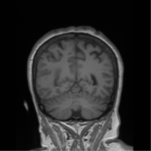 Cerebral metastasis to basal ganglia (Radiopaedia 81568-95413 Coronal T1 5).png