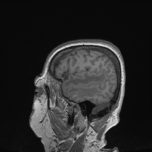 Cerebral metastasis to basal ganglia (Radiopaedia 81568-95413 Sagittal T1 66).png