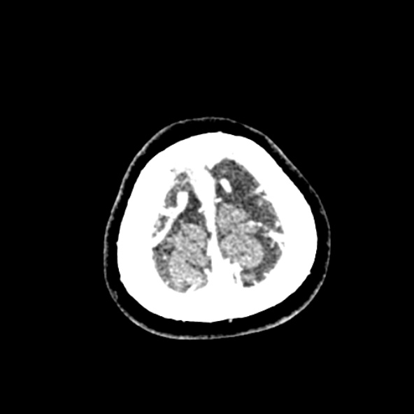 File:Cerebral ring enhancing lesions - cerebral metastases (Radiopaedia 44922-48818 B 268).jpg