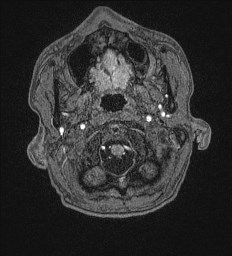 File:Cerebral toxoplasmosis (Radiopaedia 43956-47461 Axial T1 1).jpg