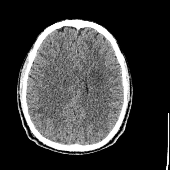 Cerebral toxoplasmosis (Radiopaedia 53993-60131 Axial non-contrast 52).jpg
