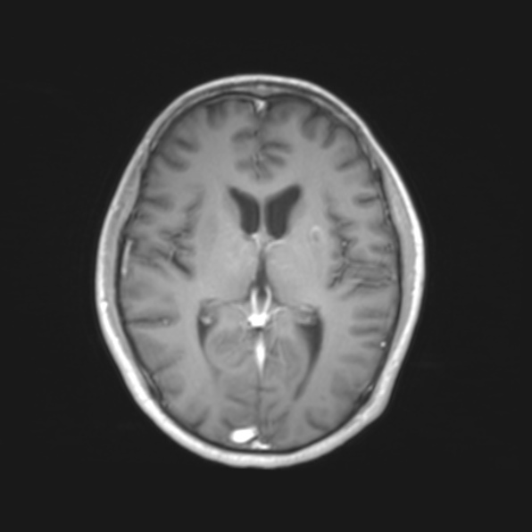 File:Cerebral toxoplasmosis (Radiopaedia 53993-61435 Axial T1 12).jpg