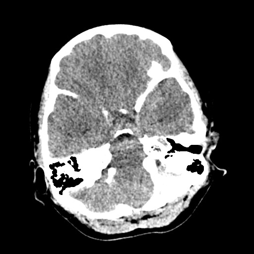 Cerebral tuberculosis with dural sinus invasion (Radiopaedia 60353-68018 Axial non-contrast 12).jpg