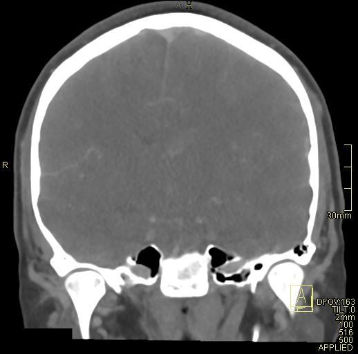 Cerebral venous sinus thrombosis (Radiopaedia 91329-108965 Coronal venogram 46).jpg