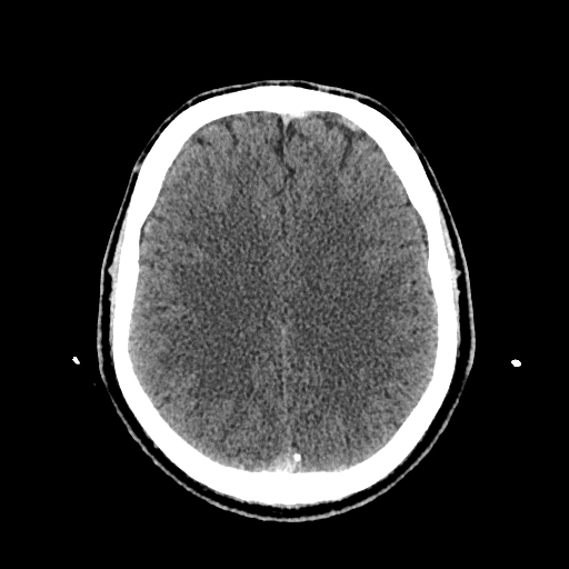 File:Cerebral venous thrombosis (CVT) (Radiopaedia 77524-89685 Axial non-contrast 32).jpg