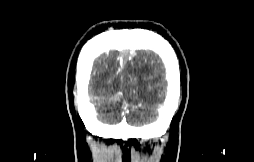 Cerebral venous thrombosis (CVT) (Radiopaedia 77524-89685 C 61).jpg