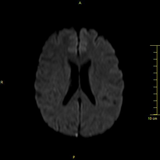 File:Cerebral venous thrombosis (Radiopaedia 23288-23351 Axial DWI 25).JPG
