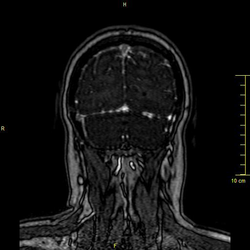 Cerebral venous thrombosis (Radiopaedia 23288-23351 MRV 150).JPG