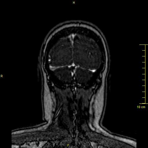 File:Cerebral venous thrombosis (Radiopaedia 23288-23351 MRV 161).JPG