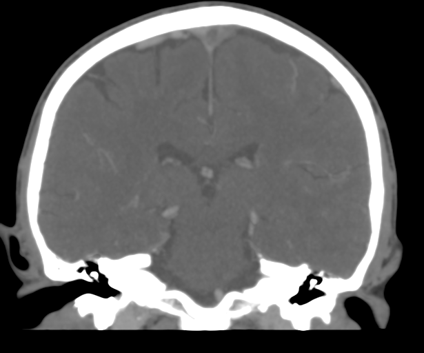Cerebral venous thrombosis (Radiopaedia 38392-40467 Coronal CTA-Venogram 37).png