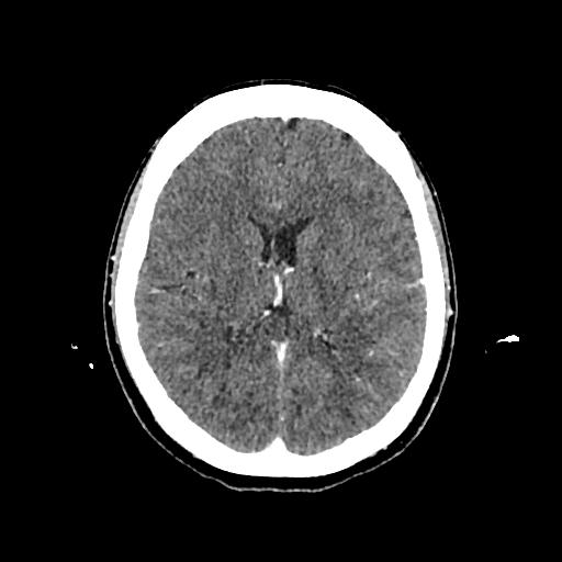 File:Cerebral venous thrombosis with venous hemorrhagic infarct (Radiopaedia 90354-107660 Axial with contrast 97).jpg