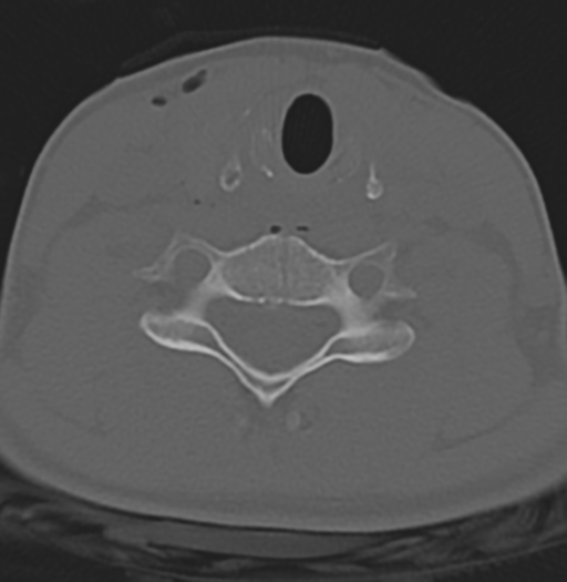 File:Cervical disc replacement (Radiopaedia 37383-39205 Axial bone window 8).png