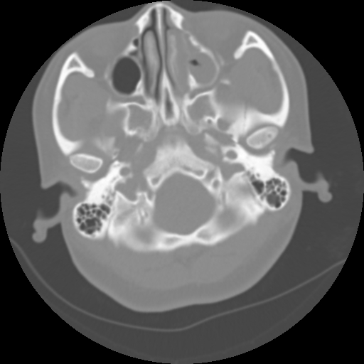 File:Cervical rib (Radiopaedia 71110-81363 Axial non-contrast 11).jpg