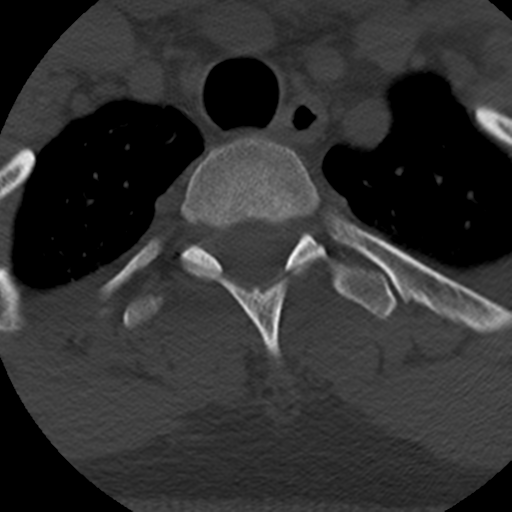 File:Cervical schwannoma (Radiopaedia 57979-64974 Axial bone window 48).png
