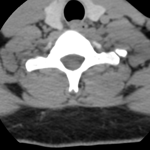 Cervical schwannoma (Radiopaedia 57979-64974 Axial non-contrast 52).png