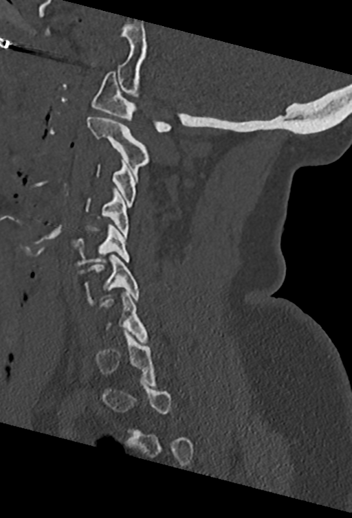 Cervical spine ACDF loosening (Radiopaedia 48998-54070 Sagittal bone window 34).png