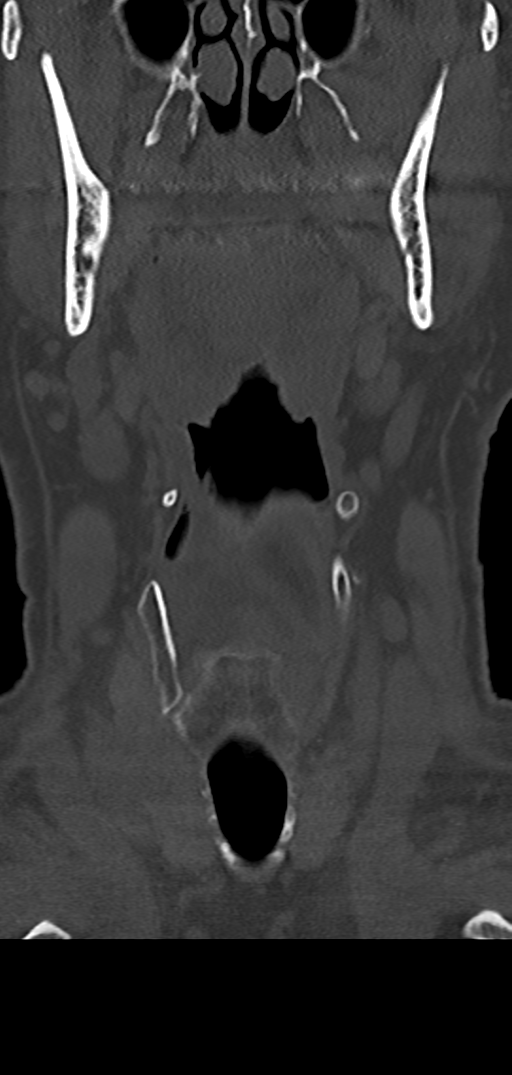 Cervical spine fracture - chalk stick (Radiopaedia 39116-41323 Coronal bone window 6).png