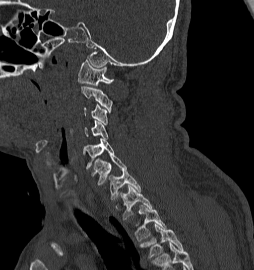 File:Cervical spine trauma with tear drop fracture and perched facet joint (Radiopaedia 53989-60127 Sagittal bone window 44).jpg