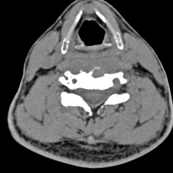 Cervical spondylodiscitis (Radiopaedia 28057-29489 Axial non-contrast 47).jpg