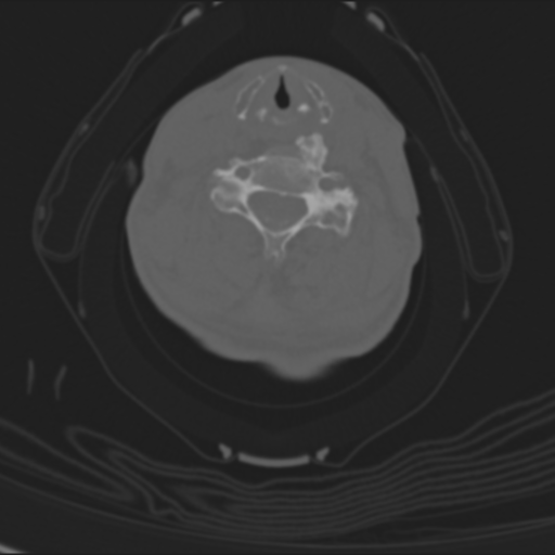 Cervical spondylolysis (Radiopaedia 49616-54811 Coronal bone window 1).png