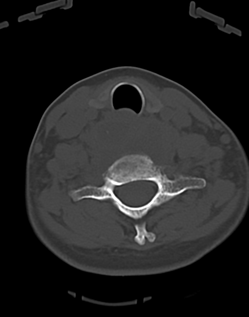 Cervical tuberculous spondylitis (Radiopaedia 39149-41365 Axial bone window 39).png