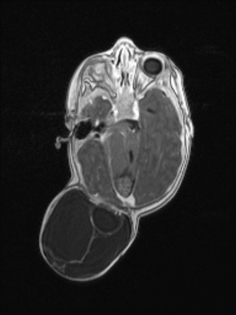Chiari III malformation with occipital encephalocele (Radiopaedia 79446-92559 Axial T1 C+ mpr 40).jpg