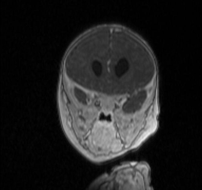 Chiari III malformation with occipital encephalocele (Radiopaedia 79446-92559 Coronal T1 C+ mpr 4).jpg