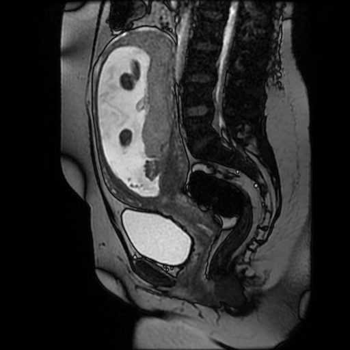 Chiari II malformation - fetal MRI (Radiopaedia 68099-77581 Sagittal Fiesta 31).jpg