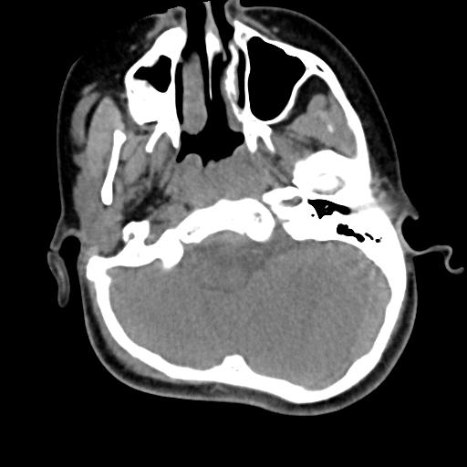 Chiari I with syrinx and skull base anomalies (Radiopaedia 89444-106412 Axial non-contrast 32).jpg