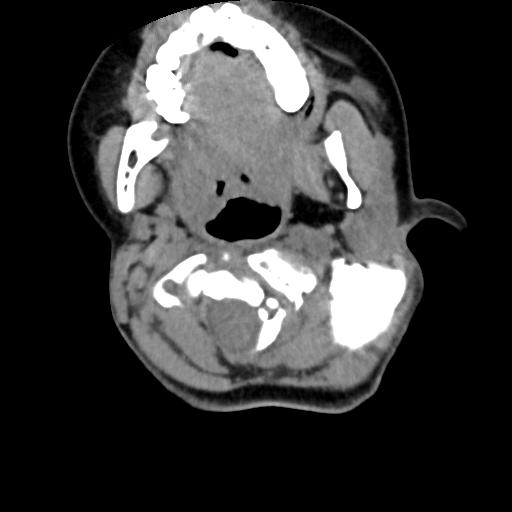 Chiari I with syrinx and skull base anomalies (Radiopaedia 89444-106412 Axial non-contrast 54).jpg