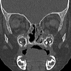 Choanal atresia (Radiopaedia 88525-105975 Coronal bone window 47).jpg
