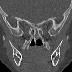 Choanal atresia (Radiopaedia 88525-105975 Coronal bone window 72).jpg