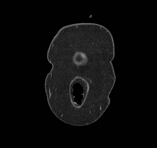 Cholecystoduodenal fistula (Radiopaedia 48959-54022 B 3).jpg