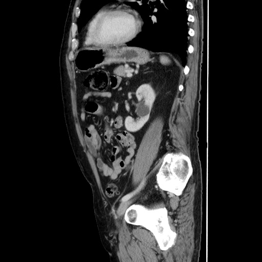 Choledocholiathiasis with normal caliber common bile duct (Radiopaedia 75368-86632 D 107).jpg