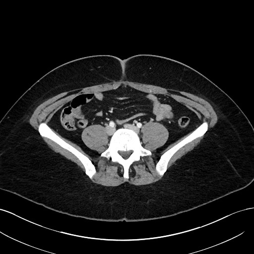 File:Choledocholithiasis after recent cholecystectomy (Radiopaedia 60929-68737 Axial 18).jpg