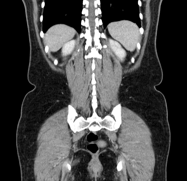 Choledocholithiasis on CT and MRI (Radiopaedia 24825-25087 C 43).jpg