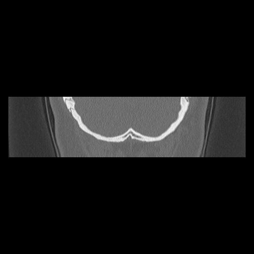 Cholesteatoma (Radiopaedia 84946-100455 Coronal bone window 150).jpg