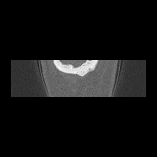 Cholesteatoma (Radiopaedia 84946-100455 Coronal bone window 168).jpg