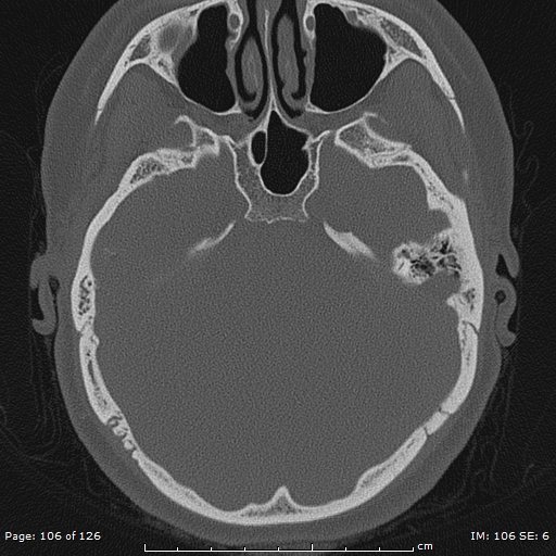 Cholesteatoma - external auditory canal (Radiopaedia 88452-105096 Axial bone window 69).jpg