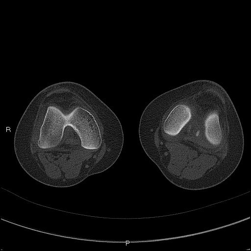 Chondroblastoma (Radiopaedia 62721-71030 Axial bone window 28).jpg