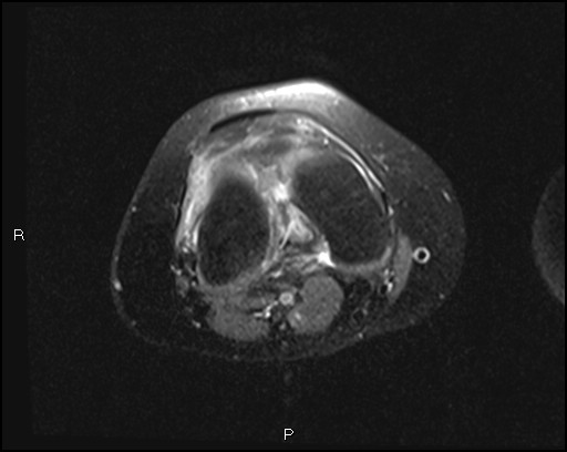 File:Chondroblastoma (Radiopaedia 62721-71031 Axial PD fat sat 18).jpg