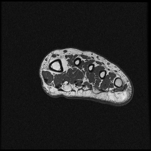 File:Chondroblastoma - midfoot (Radiopaedia 64831-73765 Short axis T1 27).jpg